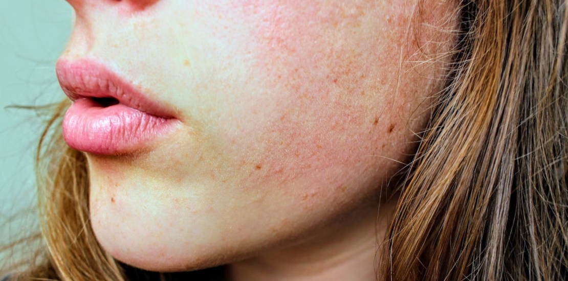 Hyperpigmentation on a Woman's Face