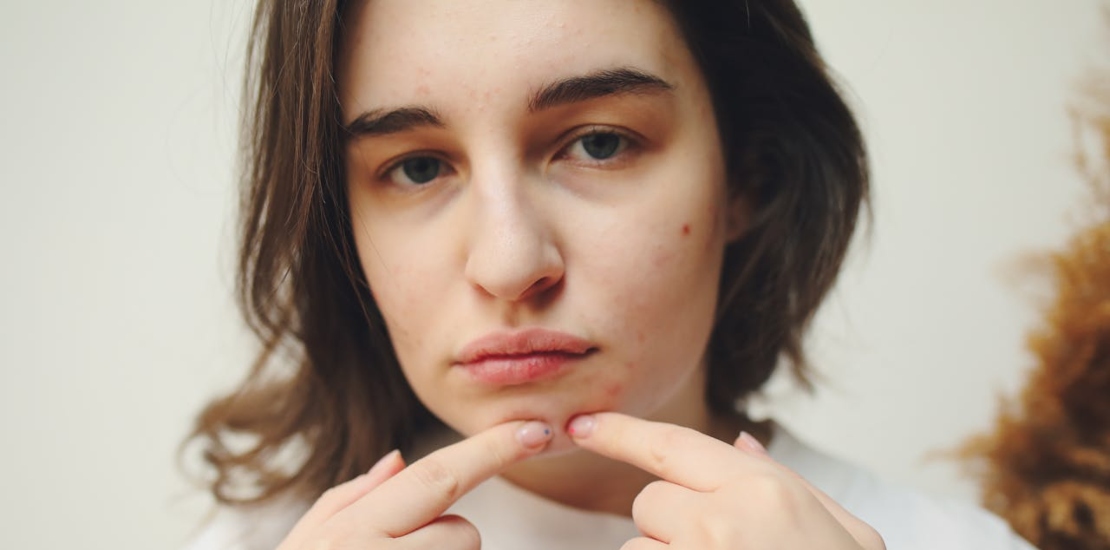 devojka sa problematičnom kožom