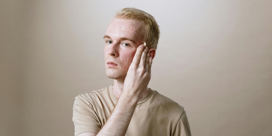 mlad čovek sa problematičnom kožom kome tretmani lica za muškarce mogu pomoći