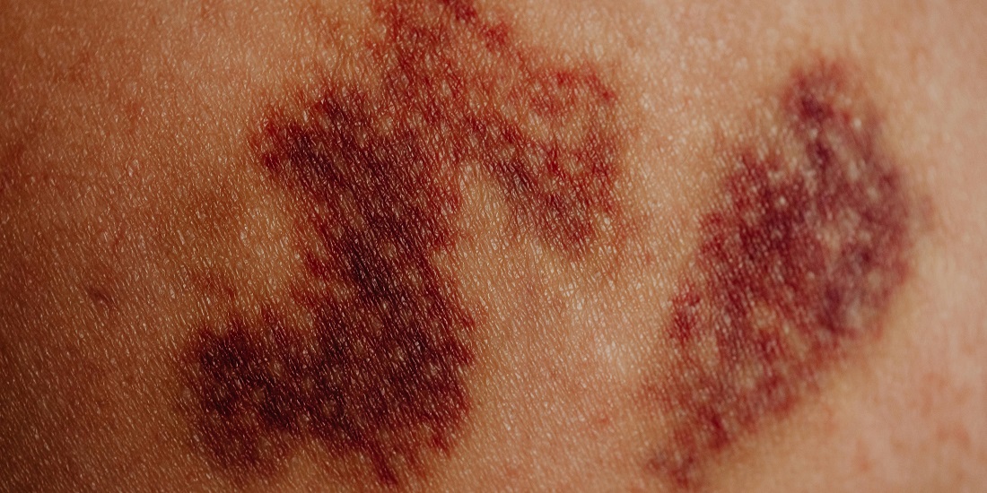 Koža sa izraženim crvenilom i proširenim kapilarima.