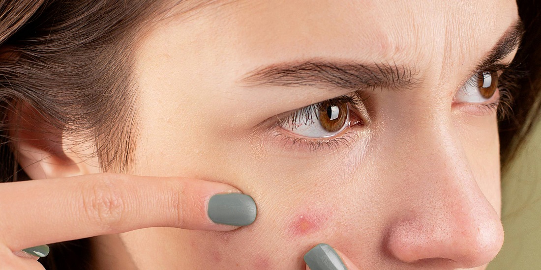 Person unaware that touching the face is one of the causes of adult acne.