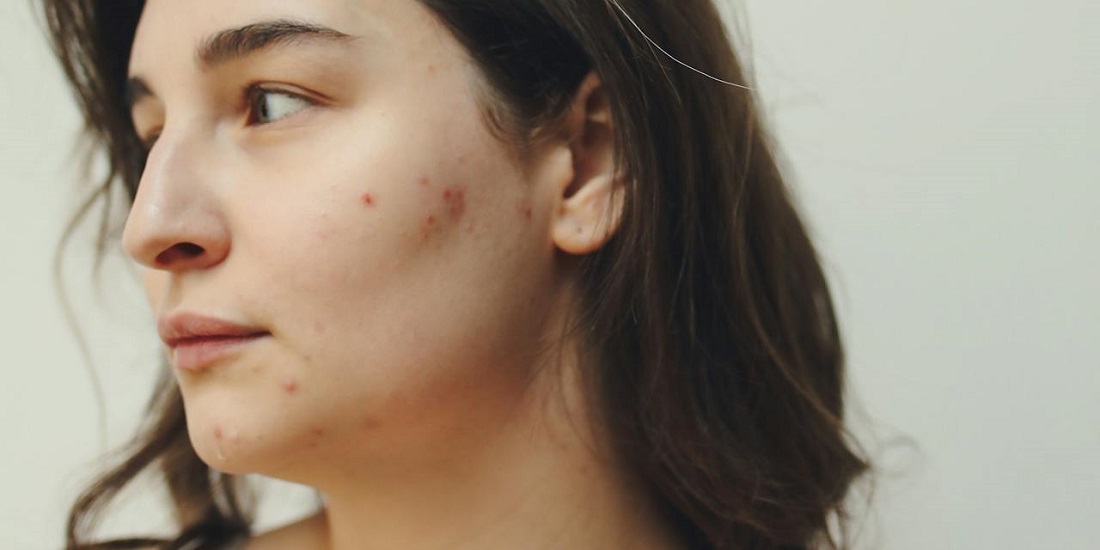 Woman with acne on her chin and cheeks, worried about the causes of adult acne