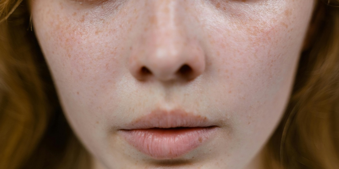 Osoba sa suvom kožom nosa