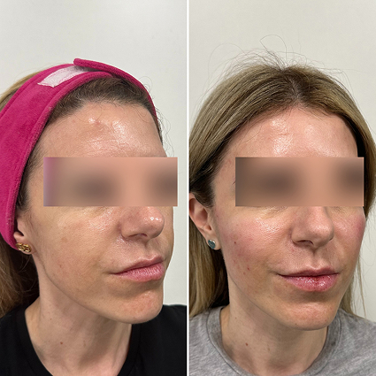 before and after treatment