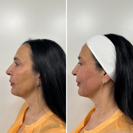 before and after treatment