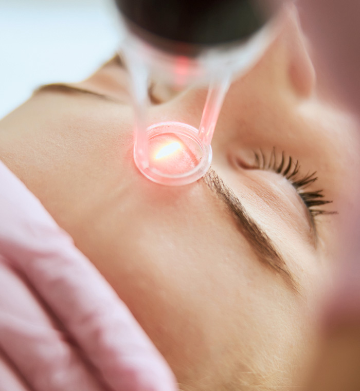 tretman lica CO2 laserom