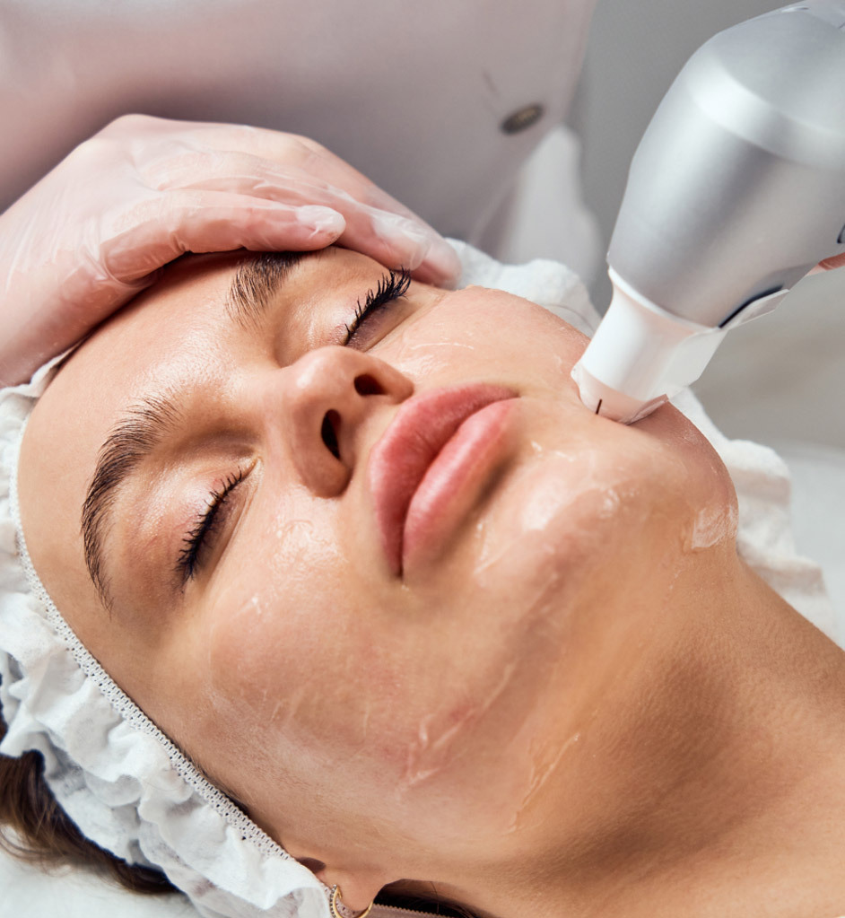 zatezanje lica ultraformerom