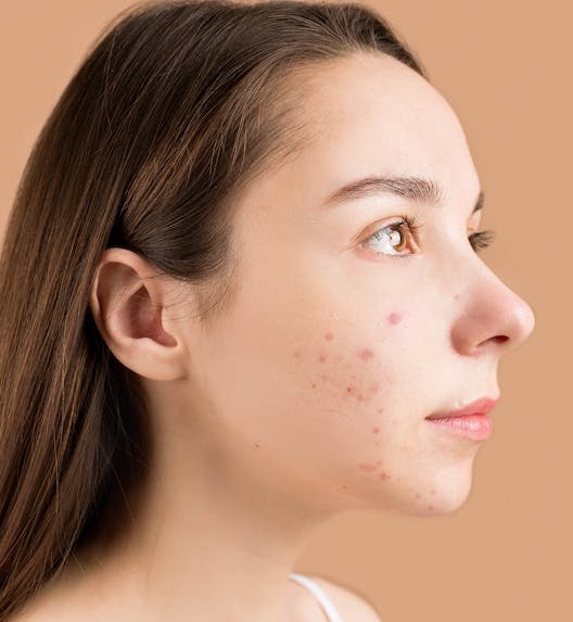 A woman with visible acne and acne scars