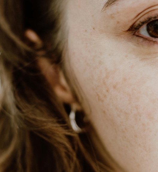 Melazma na licu žene