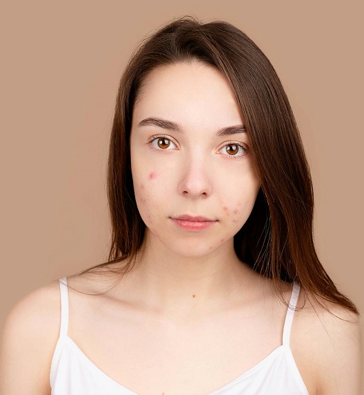 devojka koja ima bubuljice nakon tretmana lica na obrazima i bradi