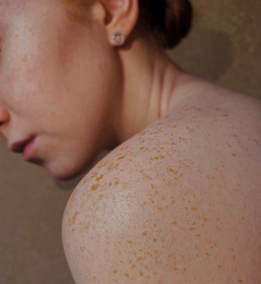 svetla koža sa izraženim pegicama na ramenu.